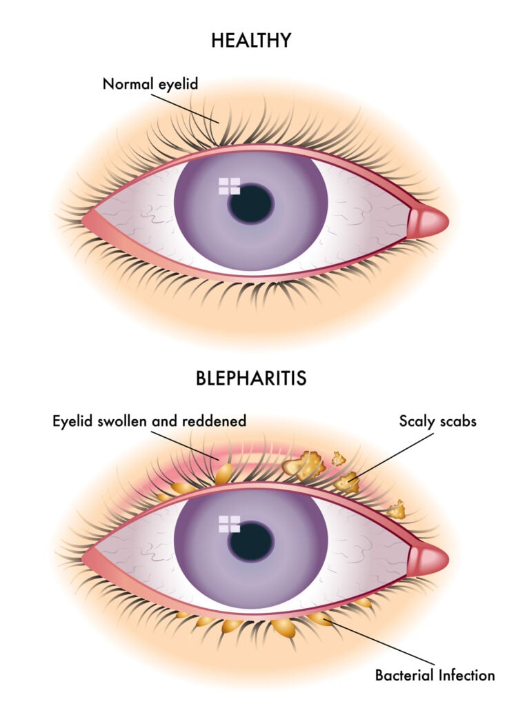 Blepharitis illustration
