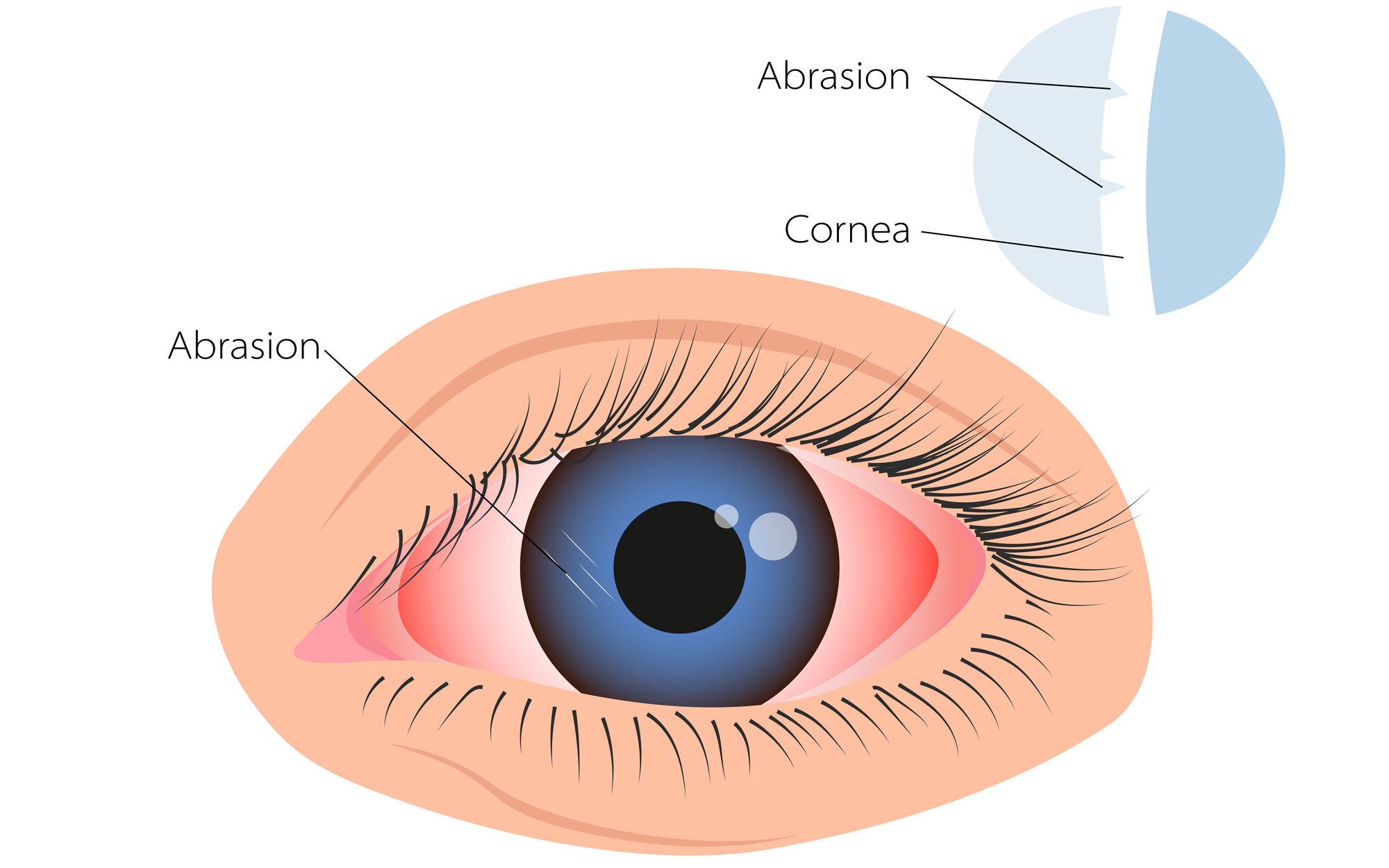 Corneal abrasion illustration