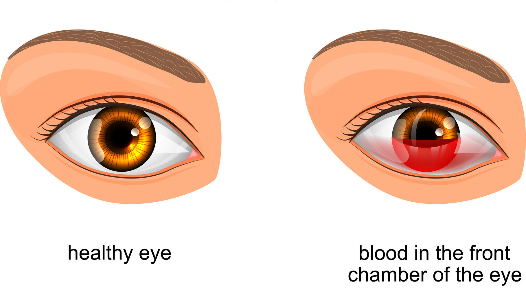 Healthy eye vs. hyphema illustration