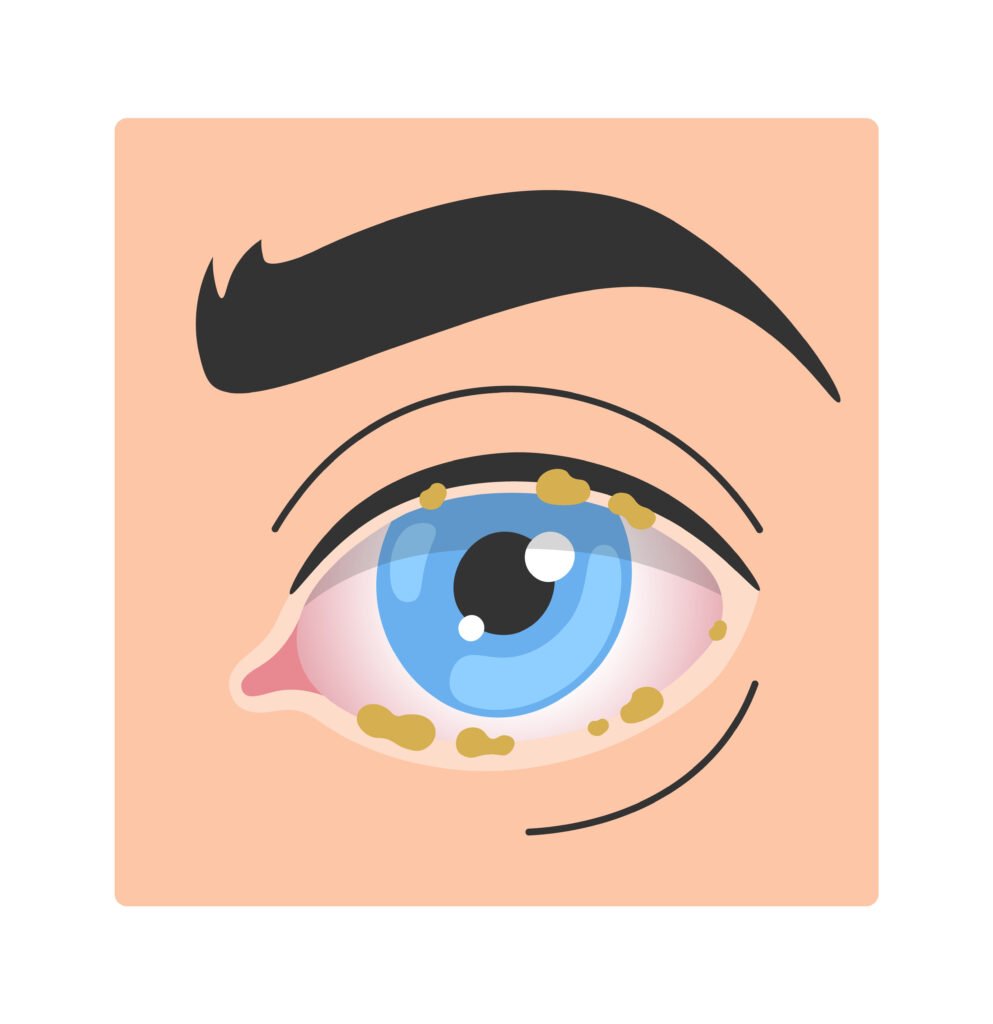 Eye discharge illustration