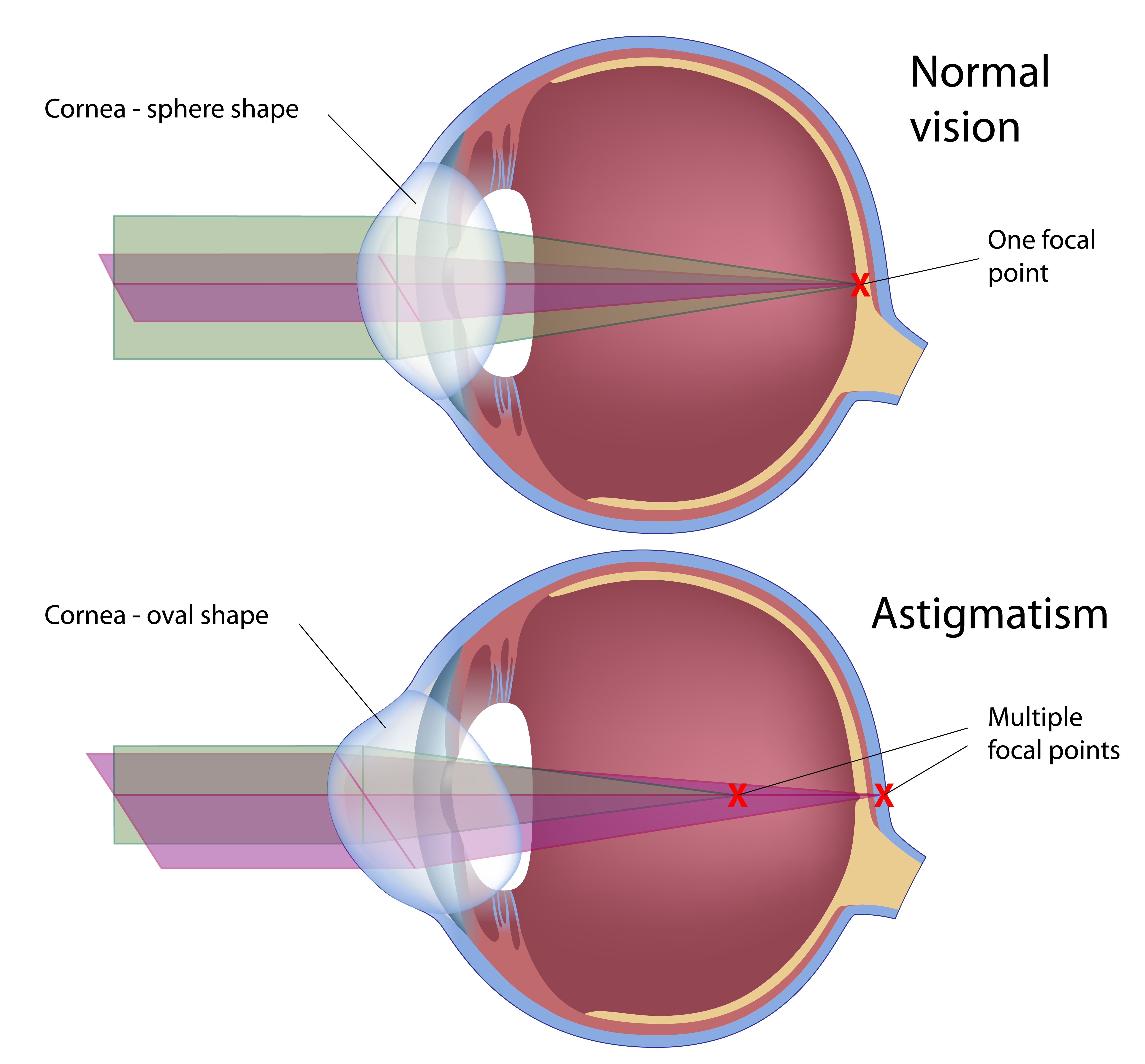 Astigmatism eye defect